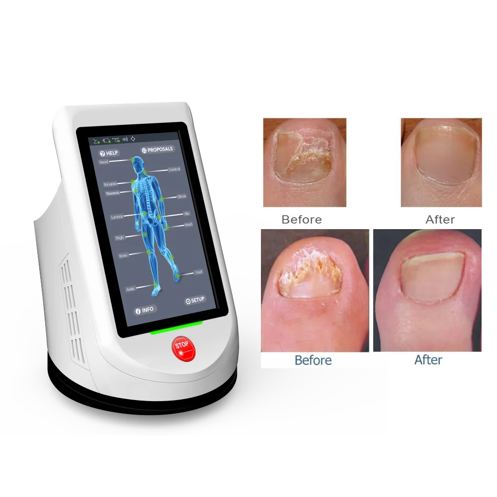 Expert 10w 15w 980nm Laser for Fungal Nail, Laser Nail