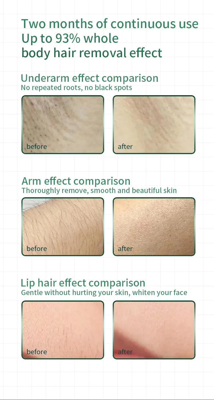 China Factory IPL Pigment Hair Removal for Facial Body Armpit Bikini