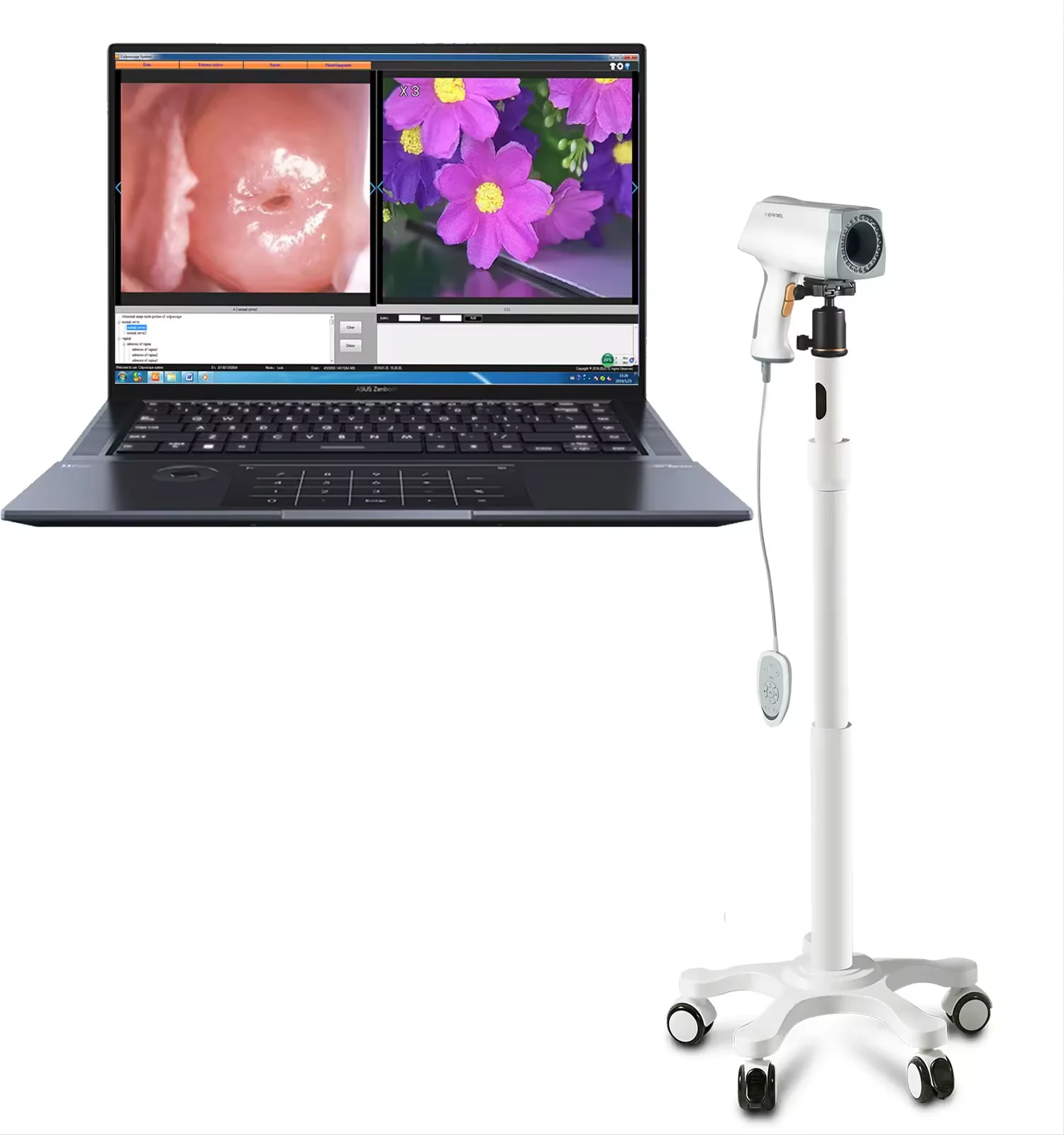 Kernel KN-2200 Portable Video Full HD Colposcopy System 1080p Digital video colposcope