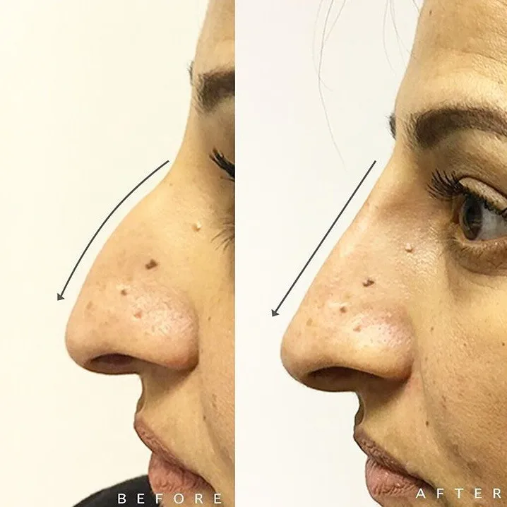 
Best Results Cross-linked 1ml 2ml Hyaluronic Acid Gel Injectable Filler with 0.3% Lido for Women to Remove Wrinkle 