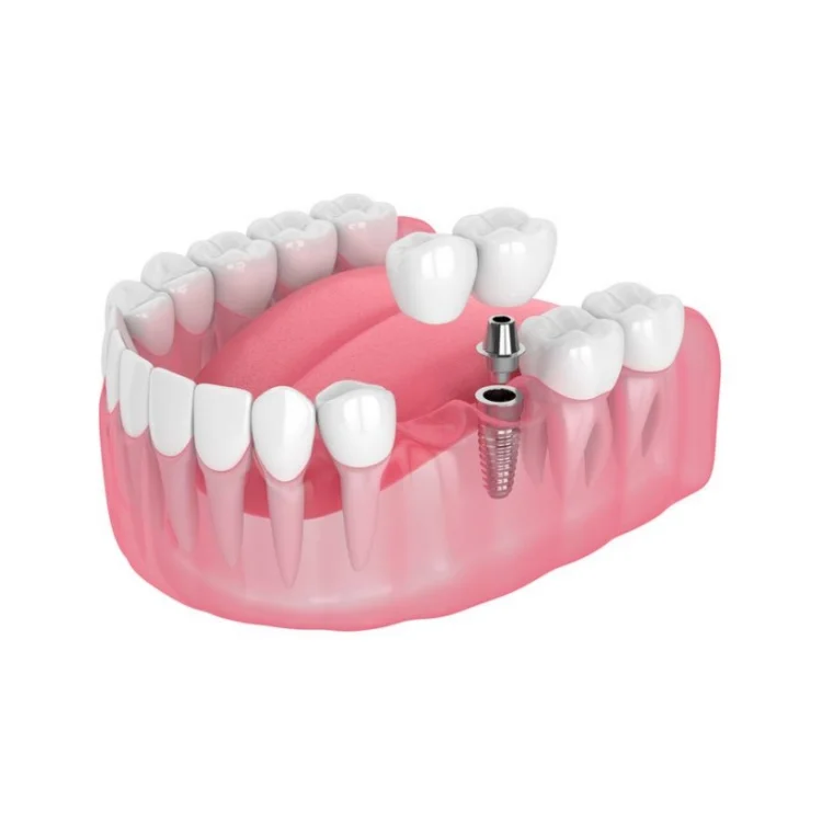 CAD Cam Designed Lab Dental Zirconia Implant Crowns and Bridge Over Titanium Bar