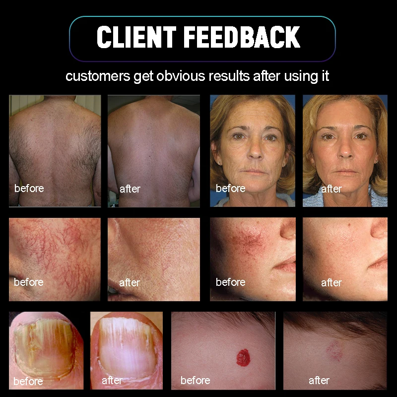 Winkonlaser Long Pulse 1064Nm 755Nm Machine Alexandrite Laser Hair Removal System