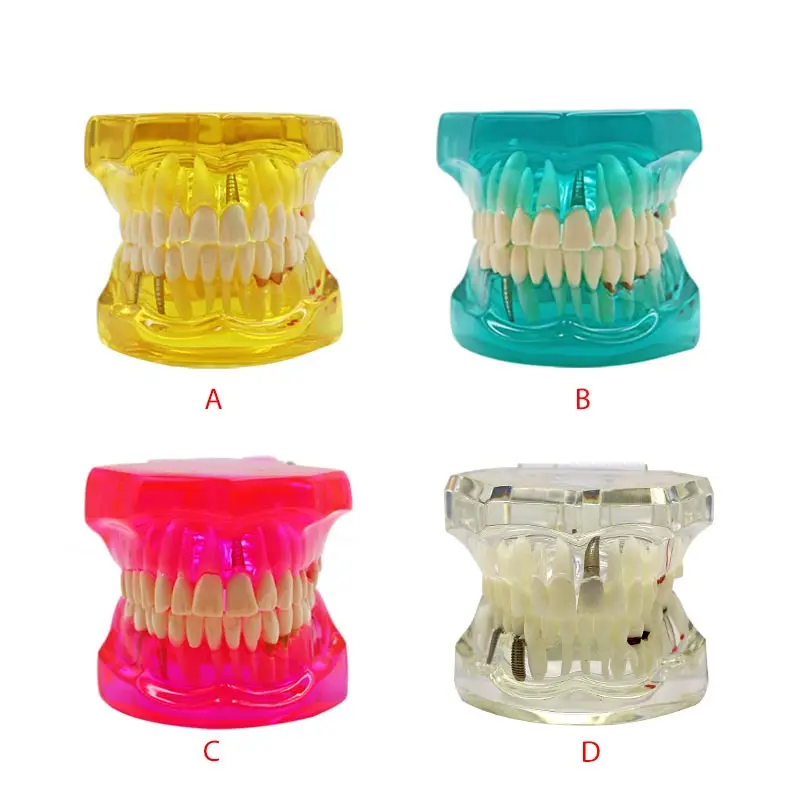Dental Disease Demonstration Study Dental Teeth Model Removable Dental Model For Dentists Schools