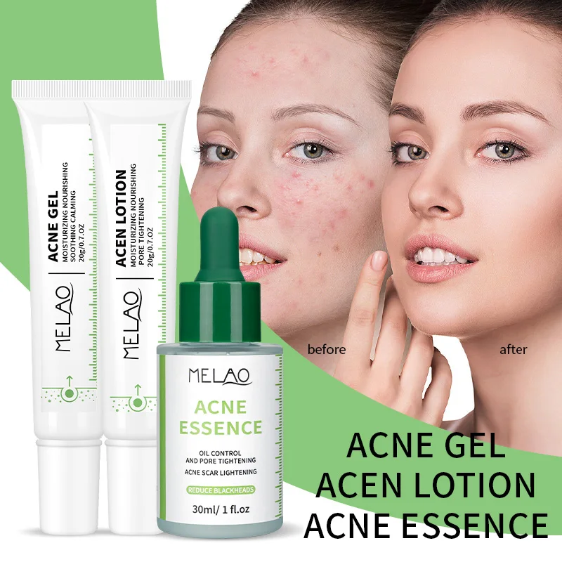 skin care acne treatment Natural Organic acne serum for acne remover scar lightening reduce blackheads