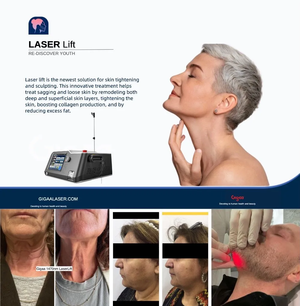 Portable 1470nm 980nm Endolifting Diode Laser Lipolysis Liposuction Fiber Lipolysis Fat Reduce Beauty Equipment