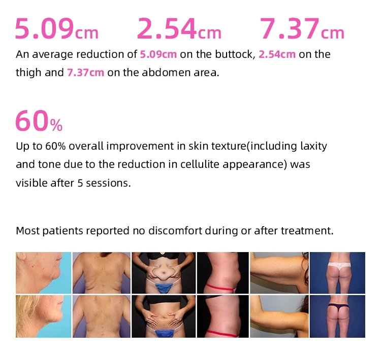 SUSLASER cavitation RF SMOOSKIN I S60 CE/ISO ultra cavitation professional machine cavitation y radiofrecuent