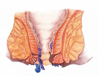 New Design 980NM Anal Piles Fistula Fissure And Pilonidal Sinus Laser External Hemorrhoid Treatment