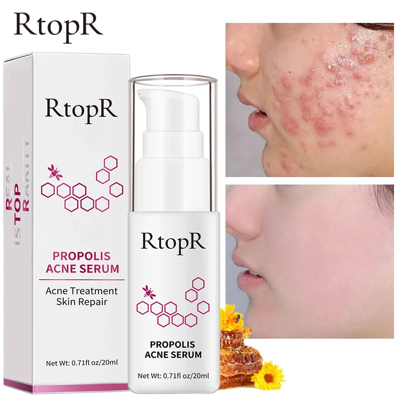 RtopR Propolis Repair Acne Brightening Serum Acne Scar Spots Cleaning Serum Shrink Pores Eliminates Acne Treatment Oil control