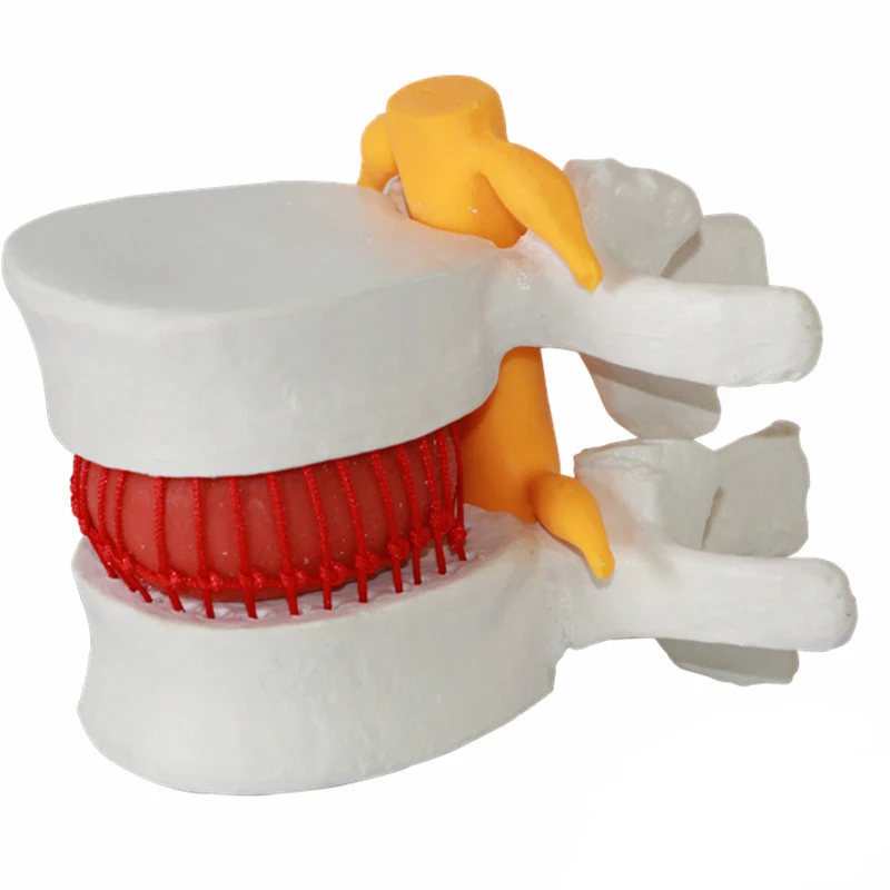 Assisted teaching Demonstration model of lumbar disc herniation Model intervertebral disc model