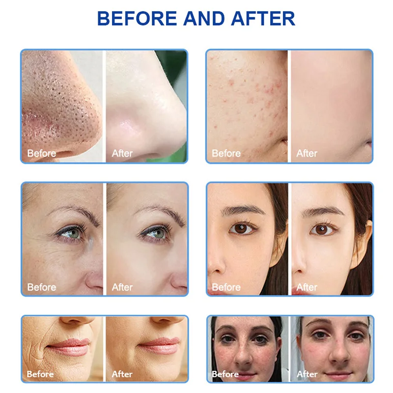 facial radio frequency micro current hydra dermabrasion electrotherapy facial machine diamond microdermabrasion with hydro