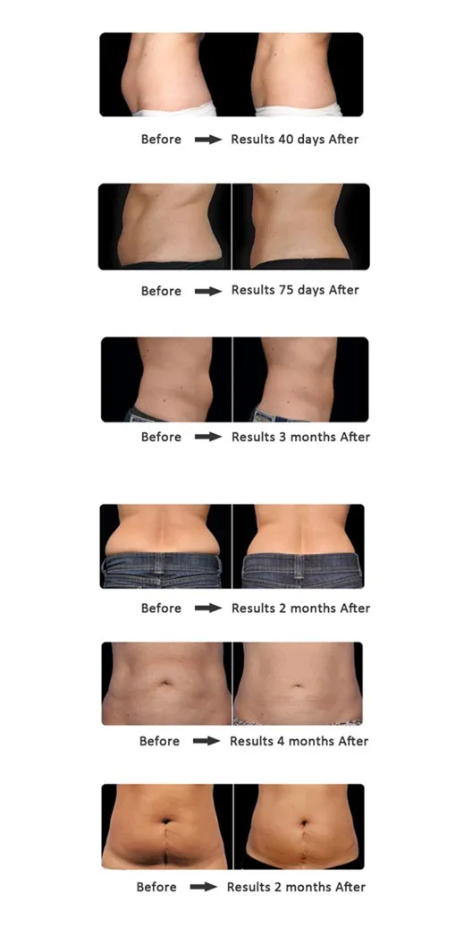 free training 20% off sincoheren 2021 the most advanced technology of fat freezing machine crolipolysis