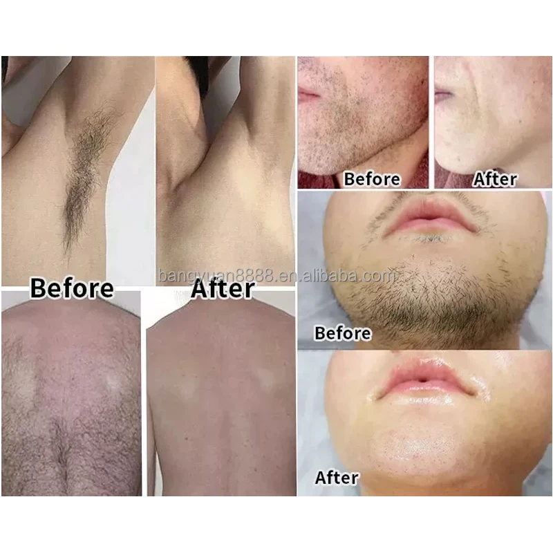 Diode Laser Portable Diodo 808Nm Depilator Laser Depilation Machine 755 808 1064 3 Wavelength Diode Laser Hair Removal Machine