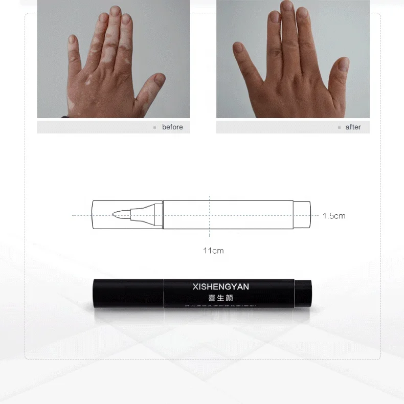 Retail Face Body White Spot Cosmetic Cream Pen Lasting Patches Makeup Waterproof Cover Concealer Vitiligo for Women Men