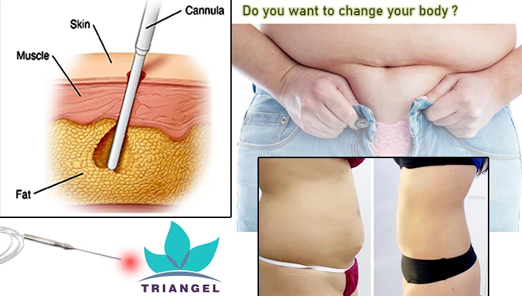 2024 newest  980nm 1470nm diode laser lipolysis endolaser face lifting  laser machine