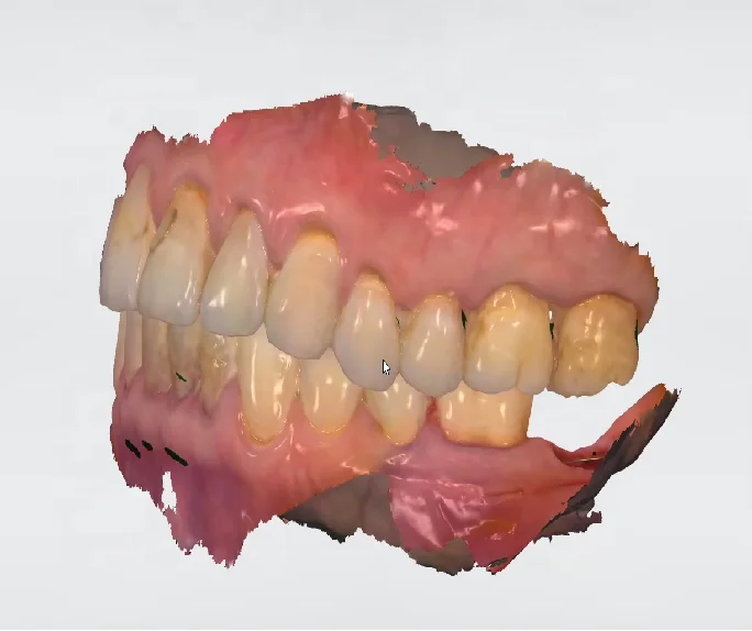 Dental Scanner Intraoral, Scanner Intraoral 3d Dental Handheld 3D Oral Scanner Digital, Impressioning Capture Intraoral Scans