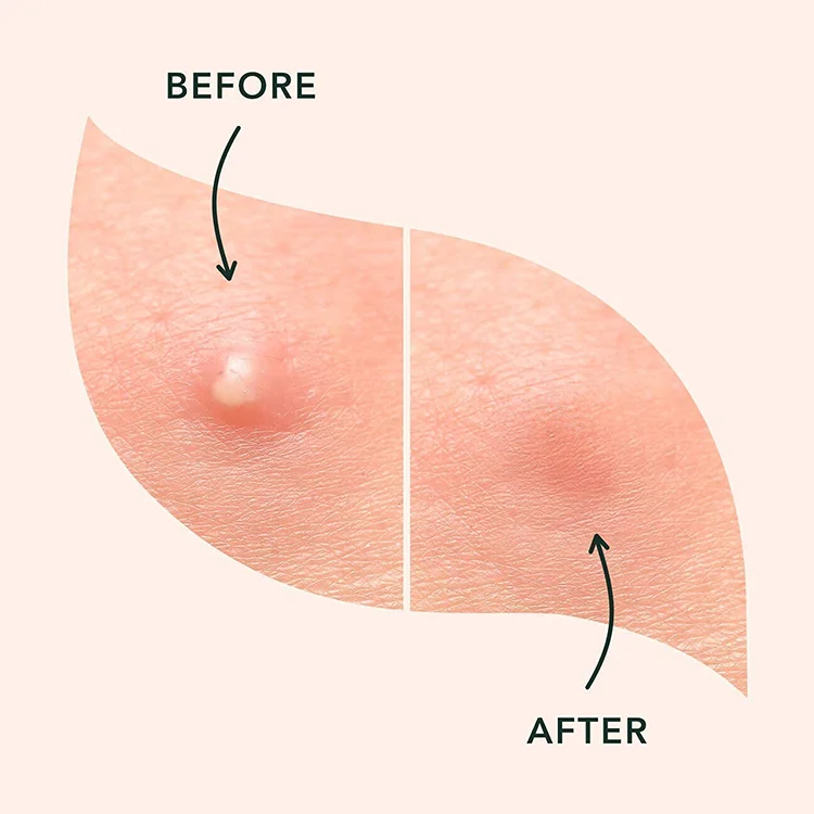 New Skin Care Customized star Invisible Waterproof Hydrocolloid Spot Acne Pimples Healing Pimple Patches