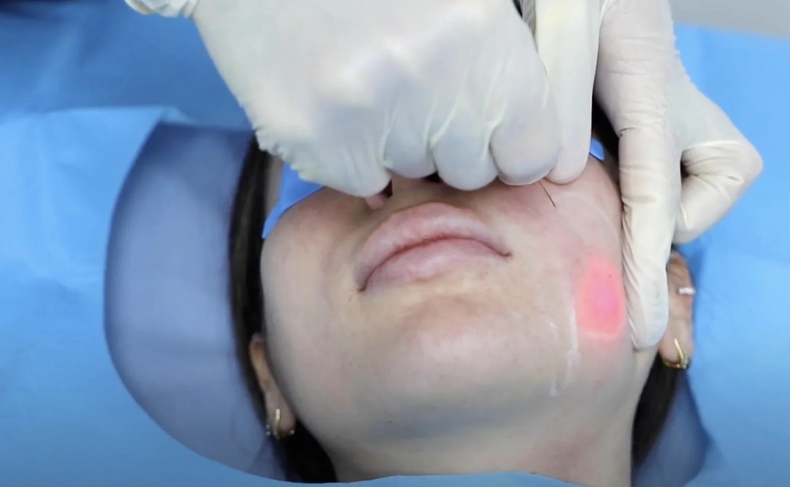 1470nm+980nm dual wavelength laser in one machine for laser lift, Lipolysis, Gynecology, Vascular multiple function Laser System