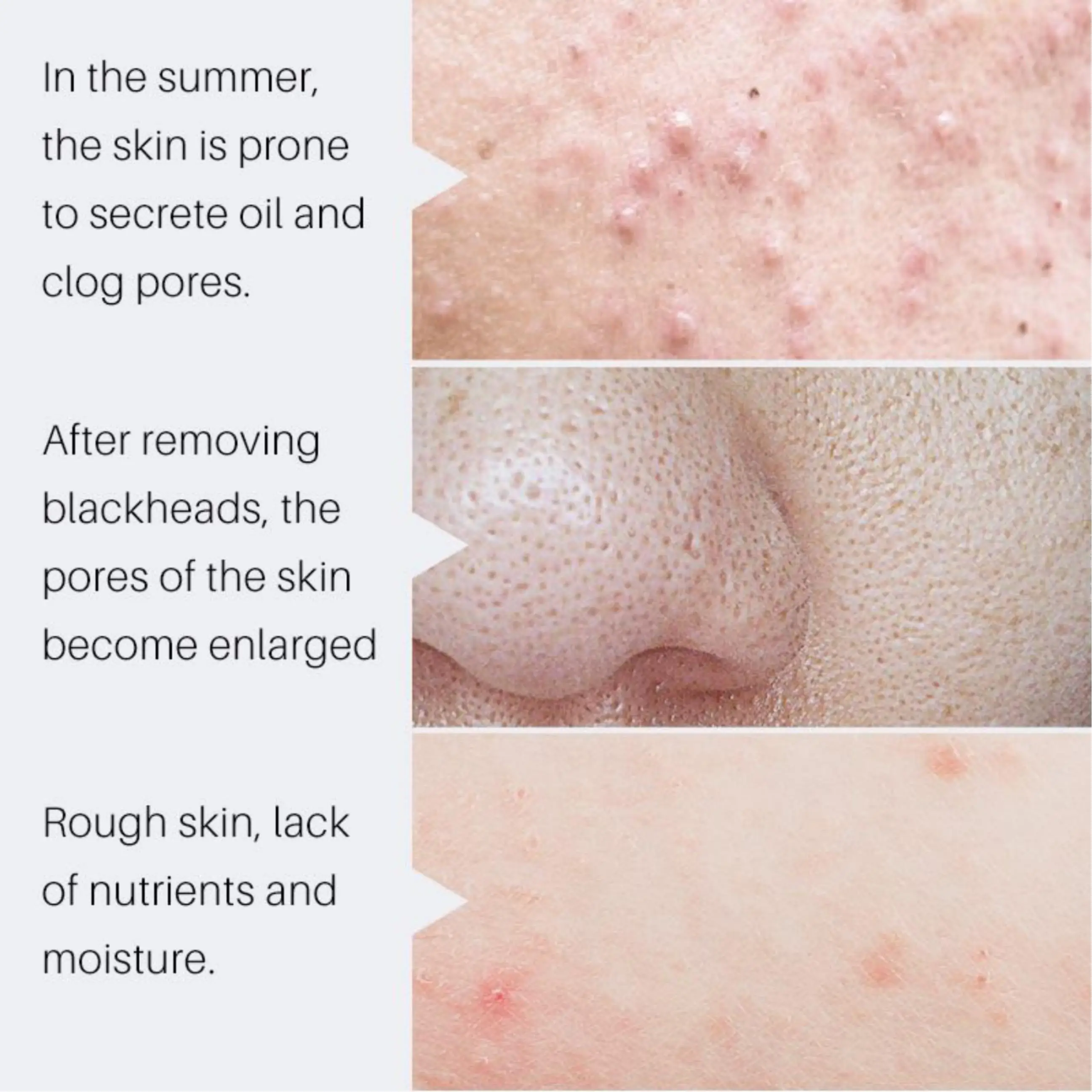 Natural Organic Acne Spot Treatment Pore Minimize Anti Acne Face Serum Acne Serum Salicylic Acid