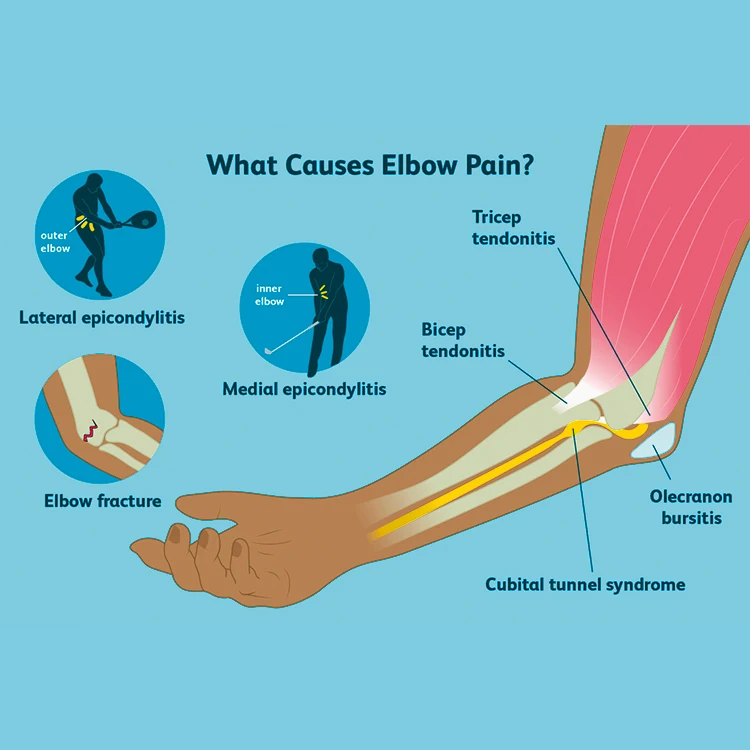 Pain in wrist joint after gym Severe sprained ankle bruising Tricep tendonitis Health care products Retail