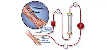 Hemodialysis-tube.jpg