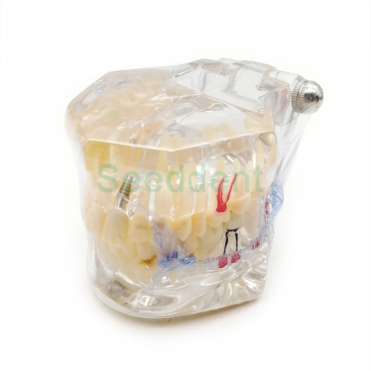 Реставрация с имплантатом модель зубных зубов имплантата обучающая