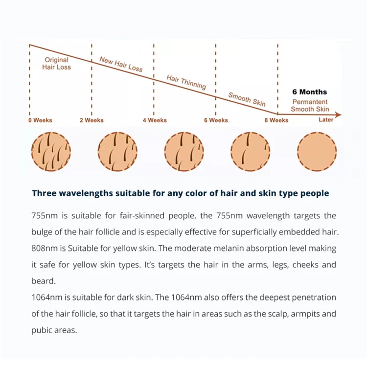 PZ LASER Hair Removal Machine Diode Laser 808nm Lightsheer Diode Ice Laser Hair Removal Germany