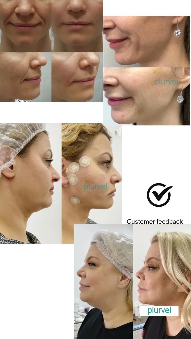 Flexible Microcannula Lips Dermal Filler Blunt Tip Cannula Needle