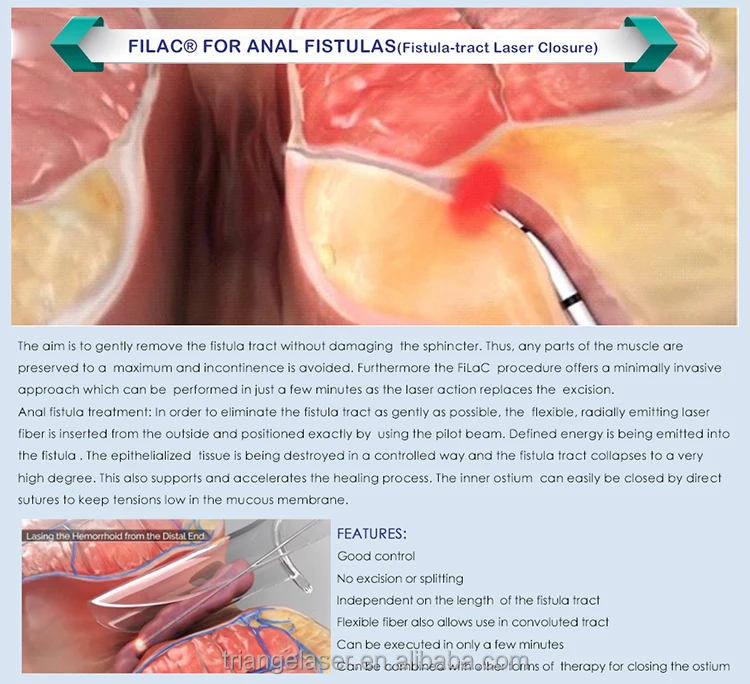 hemorrhoids-Ofelia (4)