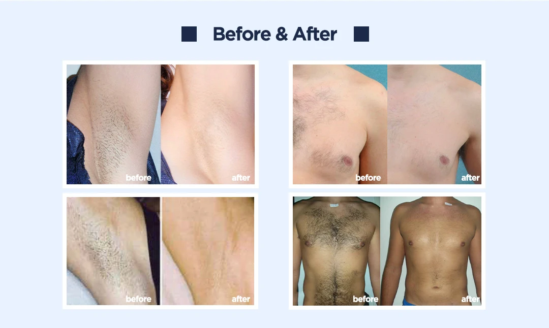 ADSS Best Selling Speed Hair Removal 808 Diode  Permanent Hair Removal Laser Machine