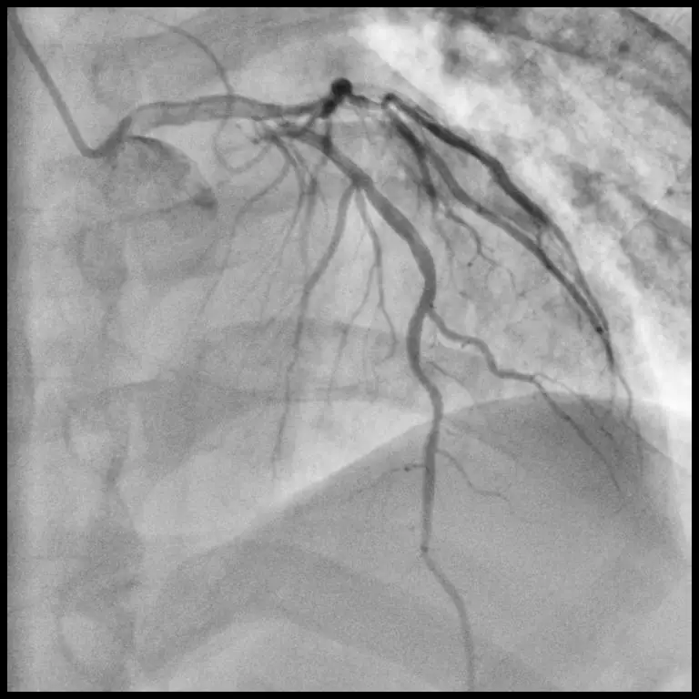 CE Approved 7 Axis Floor-Mounted C arm X-Ray Angiography Machine for cardiac intervention