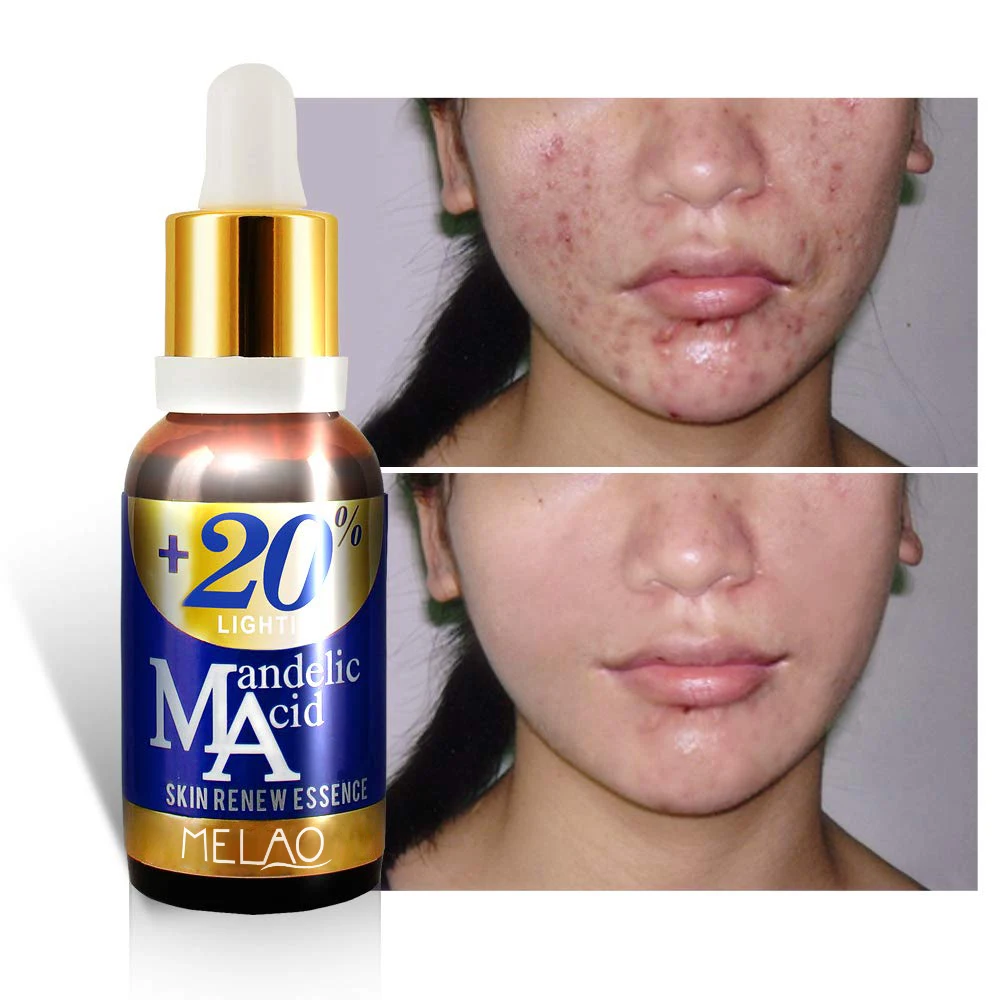 Skin care products mandelic acid serum beauty cosmetics serum anti acne Moisturizing Blemish Mandelic Acid Essential Serum