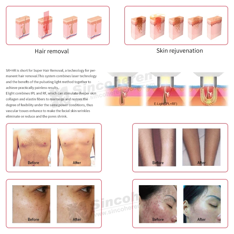 Sincoheren Ipl Skin Rejuvenation Machine Cosmetic Instrument For Salon Clinic Business Rf Beauty Equipment