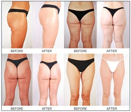 
Fat loss ultrasonic cavitation machine portable rf skin tightening machine fat reduction 