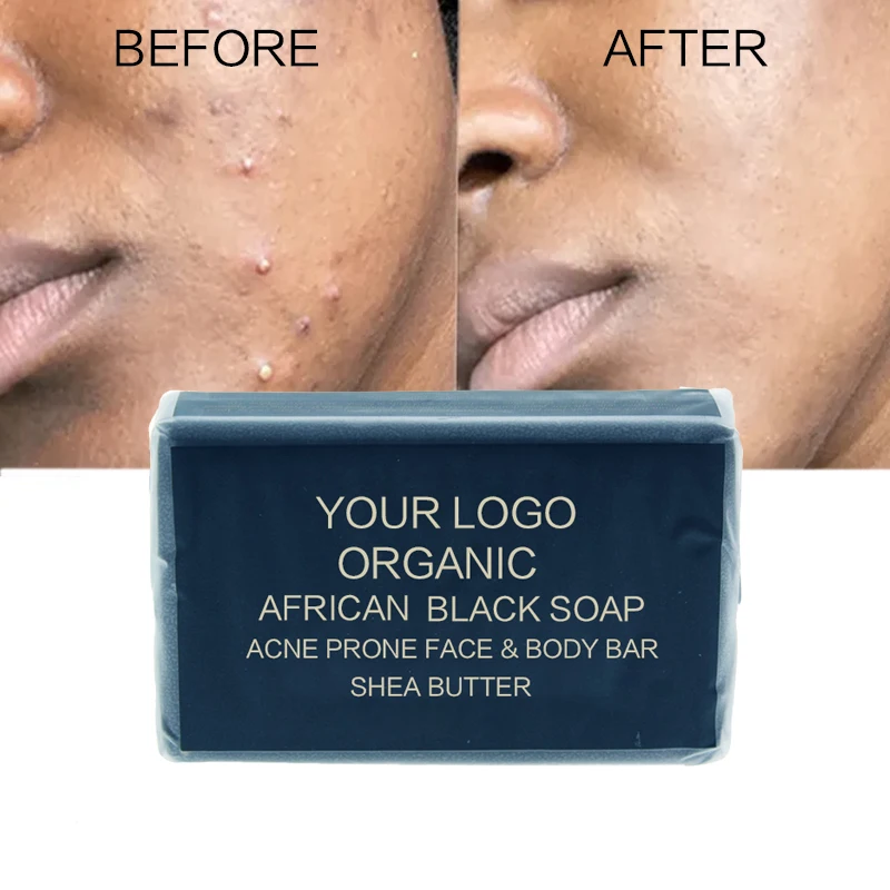 High Quality Peeling Lightening Soap,Black Skin Bleaching Anti Wrinkle Aging Kojic Acid Soap,African Anti Acne Black Toilet Soap