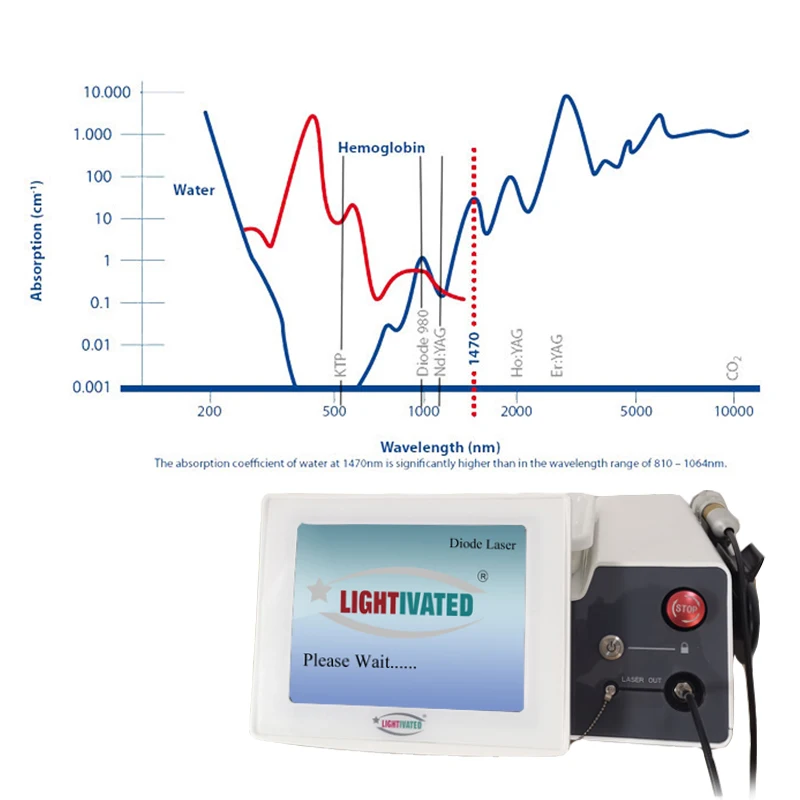 1470 hemorrhoid laser.jpg
