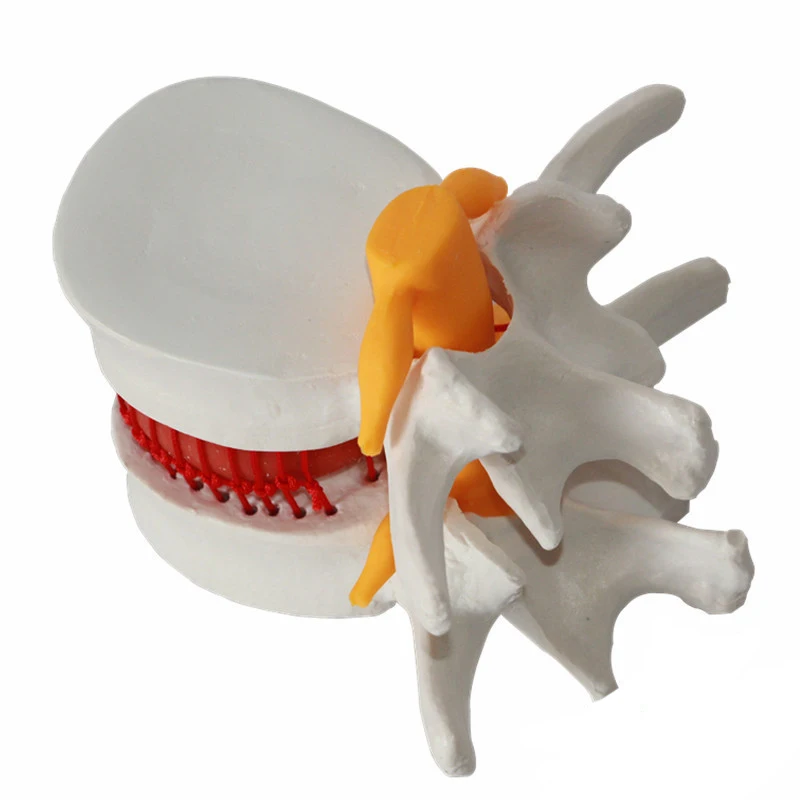 Assisted teaching Demonstration model of lumbar disc herniation Model intervertebral disc model
