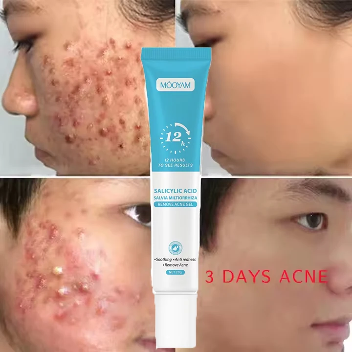 Fast Effective Repair Pimple Scar Anti Spots Removal Acne Gel Smooth Skin Shrink Pores Salicylic Acid Acne Treatment Cream