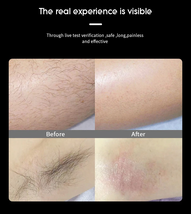 Professional promotion titanium ice diode laser depilacion hair removal 3 wavelengths diode laser 755/808/1064nm