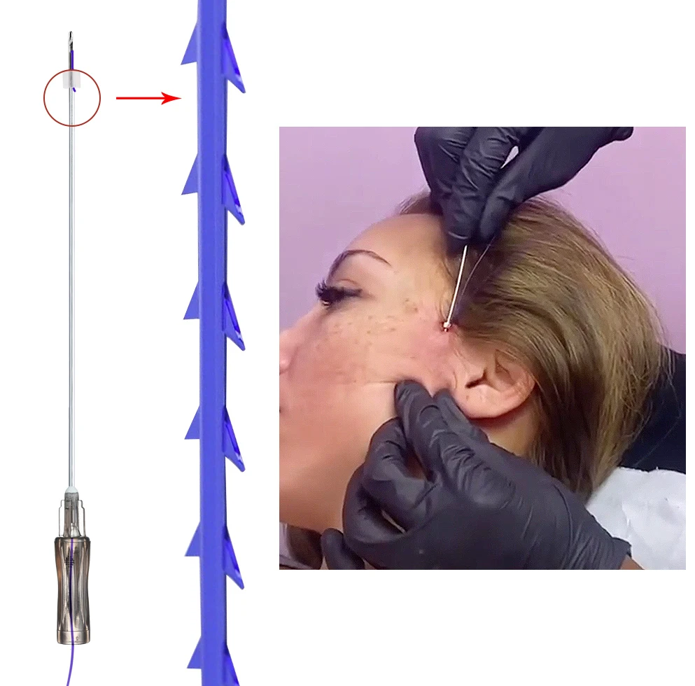 Korea Lift Thread Mono Screw 3d 4d Cog Pdo Thread Lift Abdomen With Sharp Needle