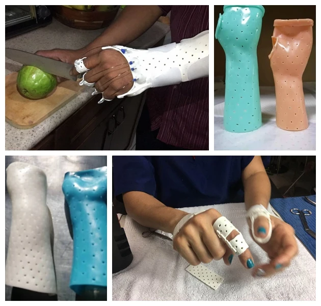 AJY thermoplastic splints.jpg