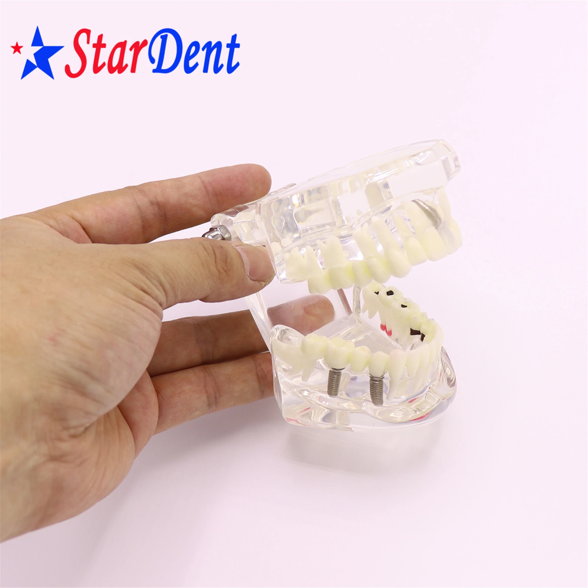 Dental  Teeth Implant Model For Tooth Implant Practicing