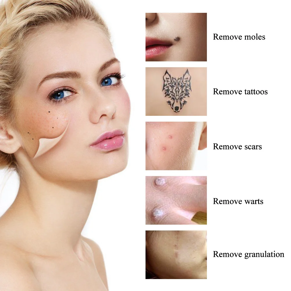 beauty machine portable skin mole removal pen skin spot remover machine