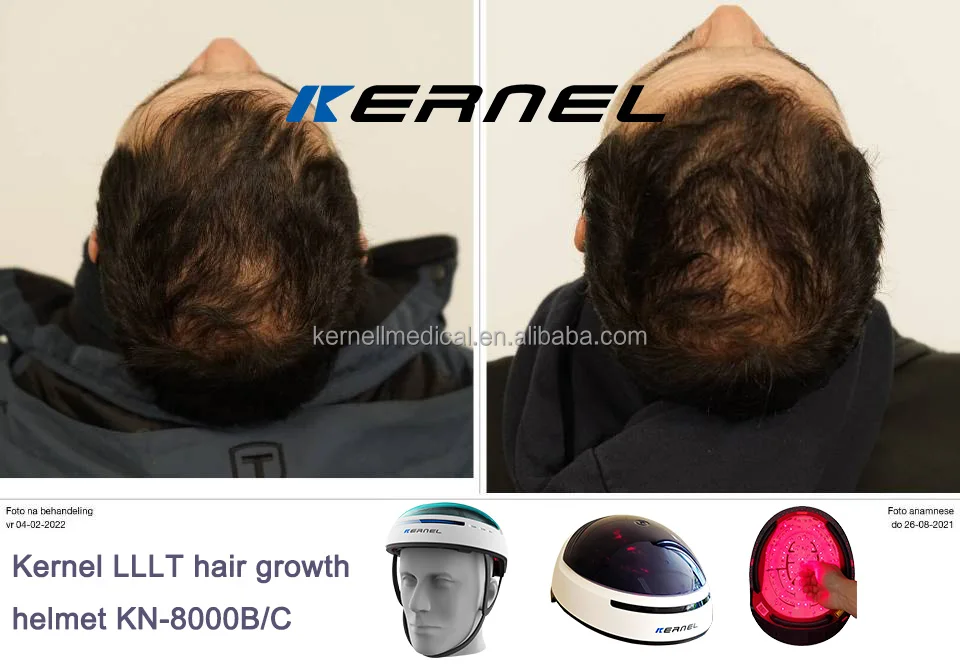 Kernel laser hair growth helmet Medical 650nm Diode Laser Hair Stimulation Growth Device For Hair Salon Use