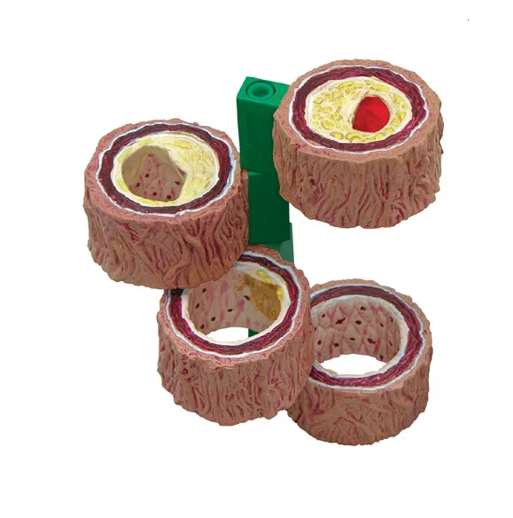 Arterial Atherosclerosis Thrombus Model Blood Vessel Anatomical