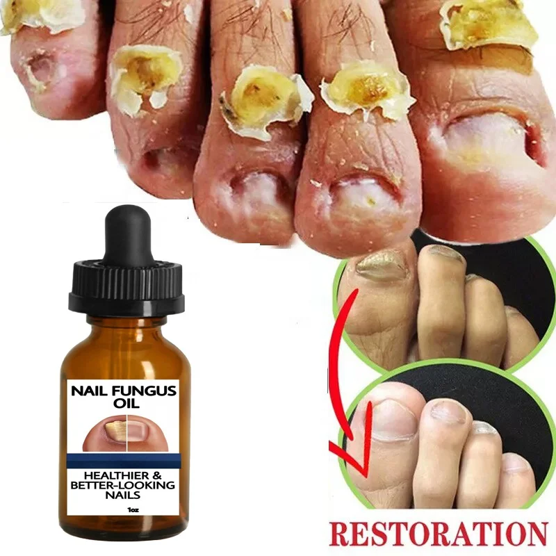 Customized Nail Fungus Oil Beautiful Healthy Nail Care Nail Fungal Treatment Serum for Hand Foot Removal Repair Gel