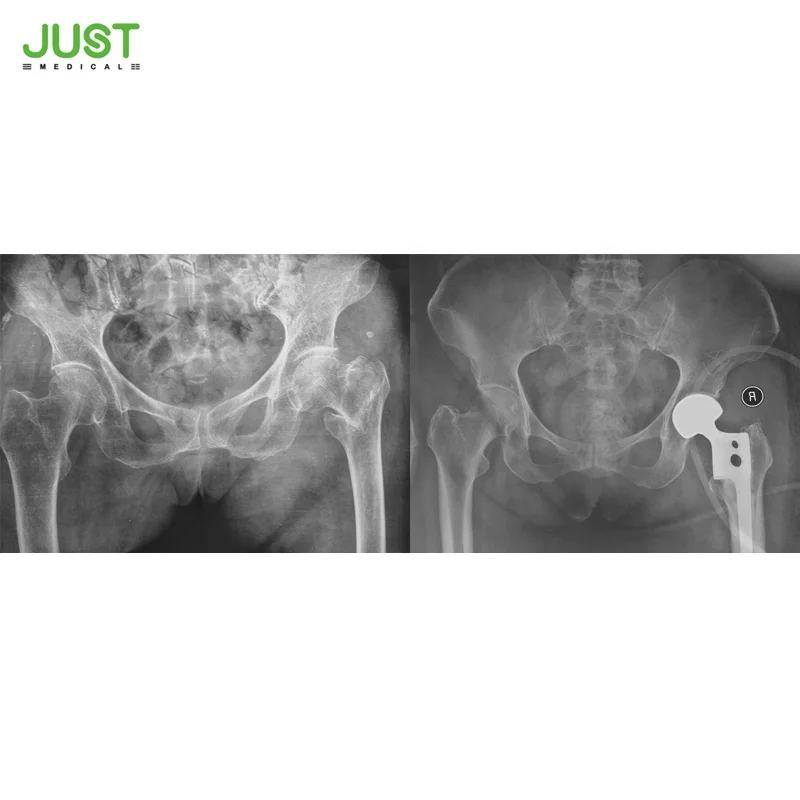 Manufacturer of hip joint femoral stem cemented hip prosthesis