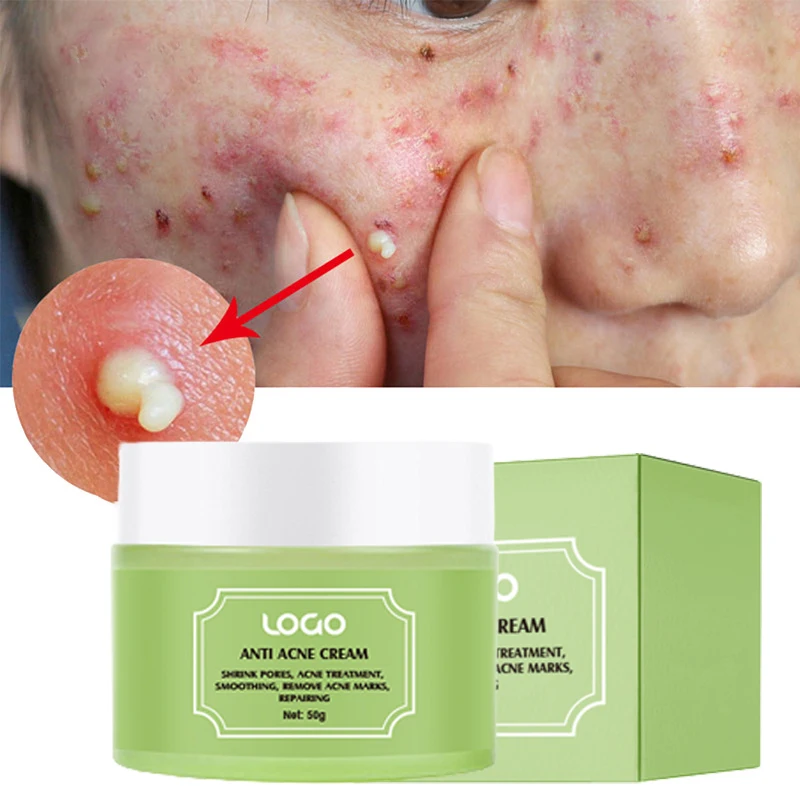 Natural Organic Tea Tree Oil Acne Scar Removal Anti Acne Face Cream