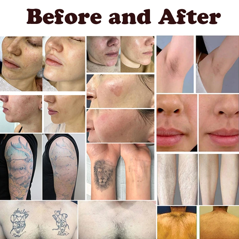 Multifunction Lumenis M22 Ipl Aopt Skin Rejuvenation Tattoo Removal Laser Hair Removal Machine Laser Lumenis M22