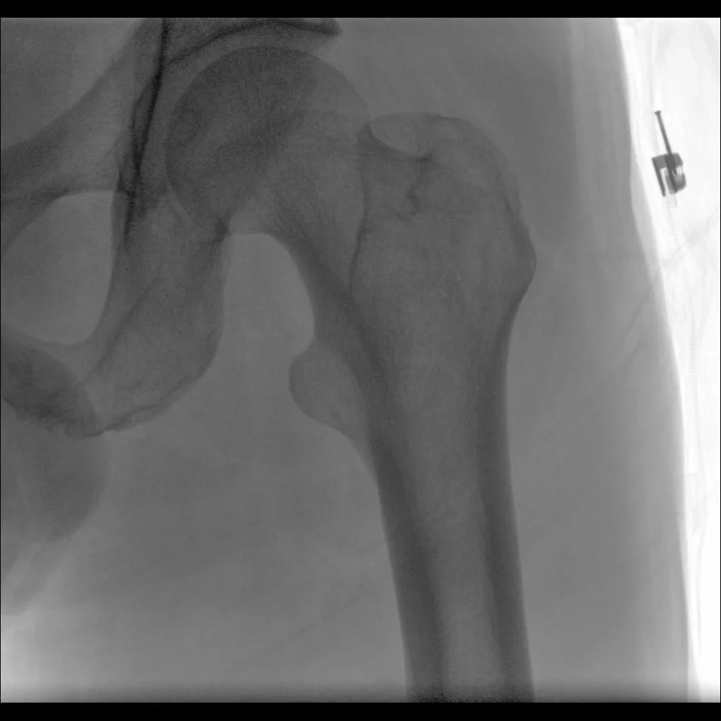 X-ray C-arm machine PLX118F what is c arm x ray machine