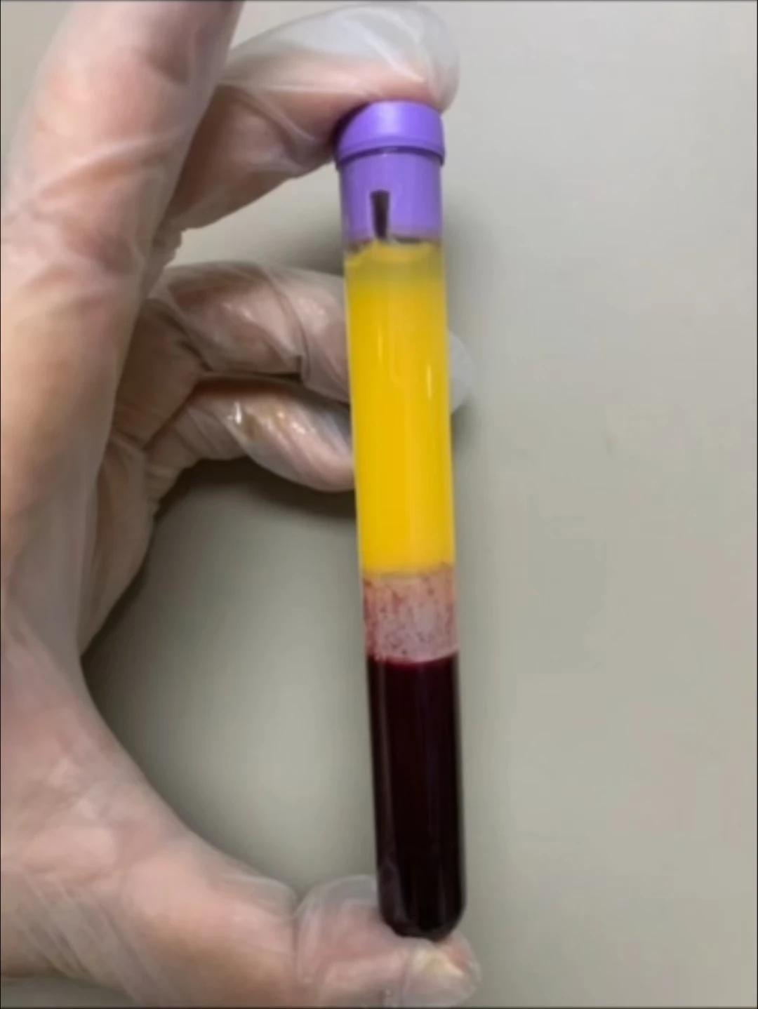 Hot Sell Cosmetic Clinical 12ml Blue Blood PRP Tube Sodium Citrate Gel PRP Injection for Face v Lifting Skin Care Knee joint